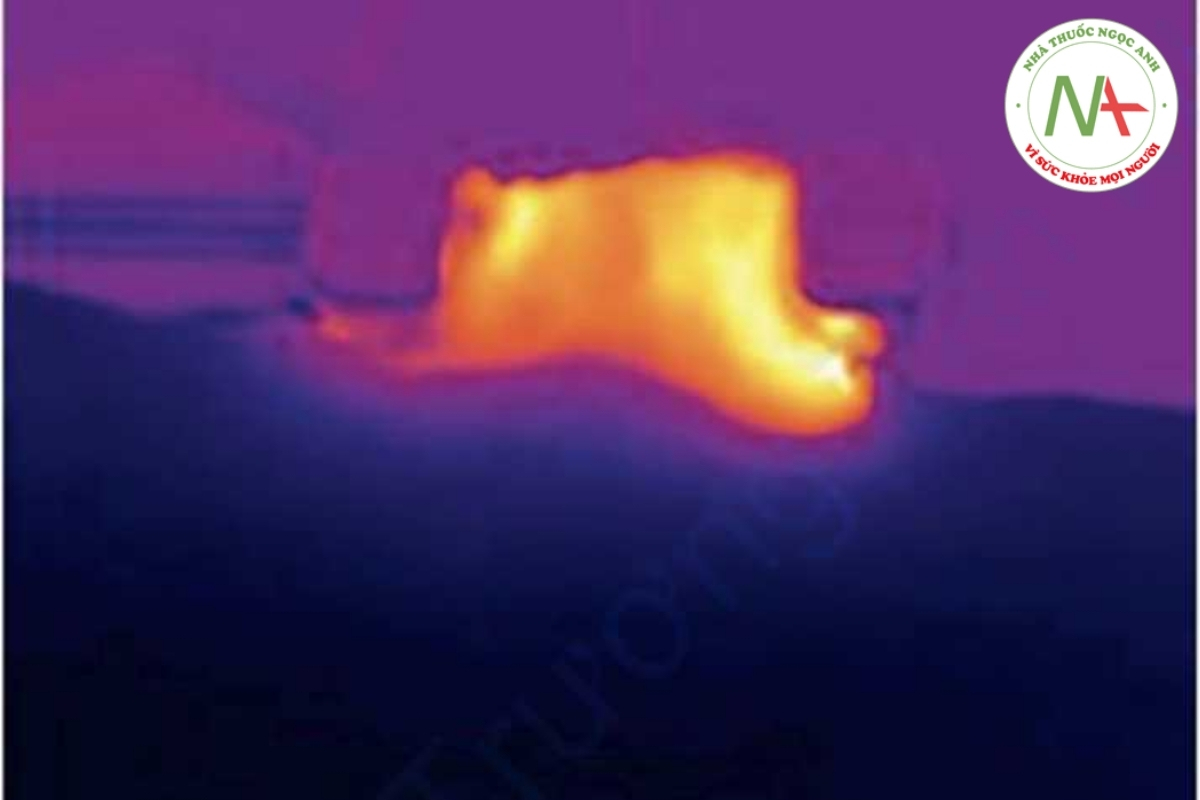 Hình 11. Hình ảnh nhiệt của sự phân bố nhiệt được tạo ra trên da được gấp giữa hai điện cực song song.