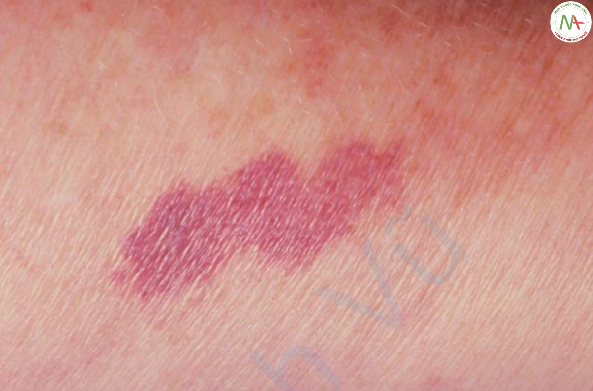 HÌNH 3 Ban xuất huyết có màu tím và không thể tẩy trắng ở bệnh nhân với làn da mỏng manh do bị tổn thương.
