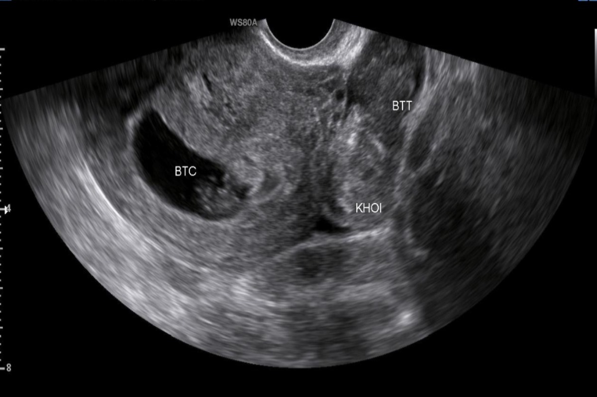 Hình 1. Hình ảnh thai trong buồng tử cung