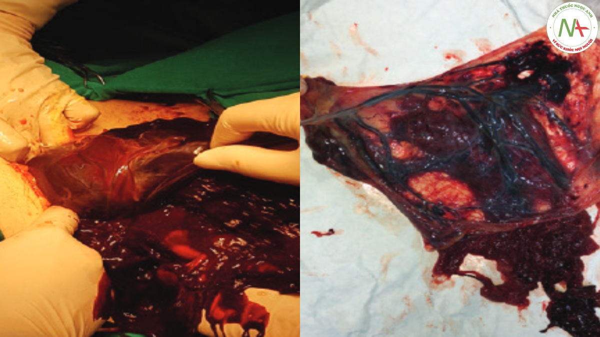Hình 2. Trong phẫu thuật thấy khối máu tụ ở bánh nhau dưới đệm (ảnh trái), dây rốn bám màng (ảnh phải).