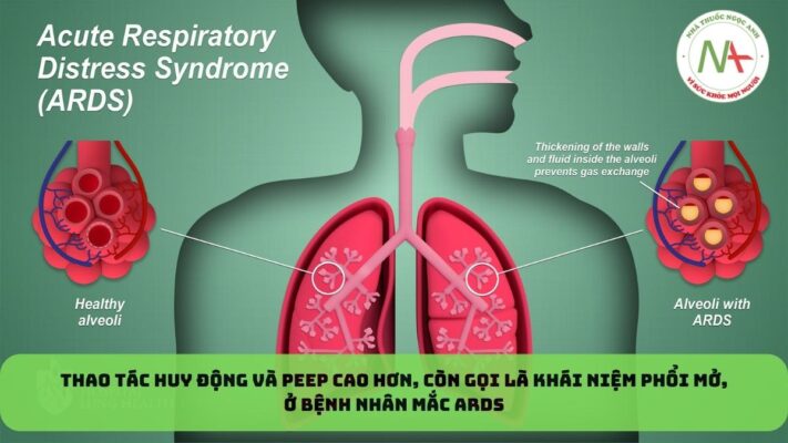 Thao tác huy động và PEEP cao hơn, còn gọi là Khái niệm phổi mở, ở bệnh nhân mắc ARDS