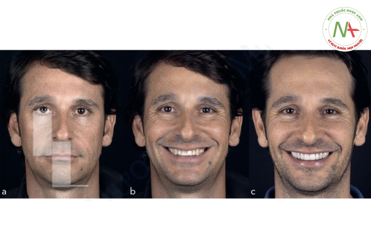 Hình 2-10 (a) Bệnh nhân giảm OVD. Các hình chữ nhật có chiều dài bằng nhau được sử dụng để xác minh xem khoảng cách từ rãnh ngoài mí mắt đến mép má có giống như khoảng cách từ góc mũi môi đến gốc cằm hay không. (b và c) Hình ảnh nụ cười trước và sau điều trị. Lưu ý rằng OVD tăng lên khi tiêm BTX và phục hồi răng.