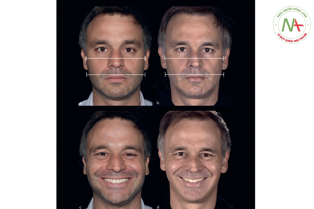Hình 2-12 (a) Bệnh nhân có chiều rộng 1/3 dưới tăng. Lưu ý rằng khoảng cách bigonial gần bằng khoảng cách bizygomatic. Cũng lưu ý đến sự bất đối xứng (rộng hơn ở phía bên trái của khuôn mặt). (b) Các phép đo sau khi tiêm BTX. Lưu ý sự giảm khoảng cách bigonial và tính đối xứng đạt được ở 1/3 dưới. (c và d) Nụ cười trước và sau điều trị.