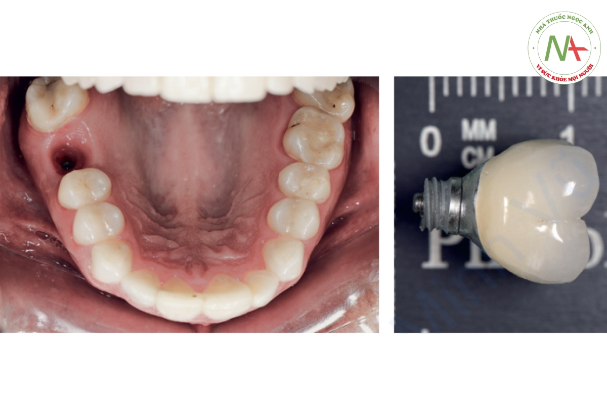 Hình 2-13 (a và b) Ví dụ về rối loạn chức năng: Gãy xương hiếm gặp ở cấy ghép Brânemark do bị siết chặt. Bộ cấy và mão răng của nó đã hoạt động được 10 năm.