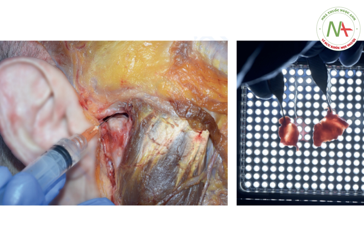 Hình 2-14 (a) TMJ trên xác tươi sau khi chọc hút màng hoạt dịch. (b) Đĩa khớp bên trái thuộc về một xác chết có răng bị mòn. Đĩa bên phải là của một bệnh nhân có răng được bảo tồn.