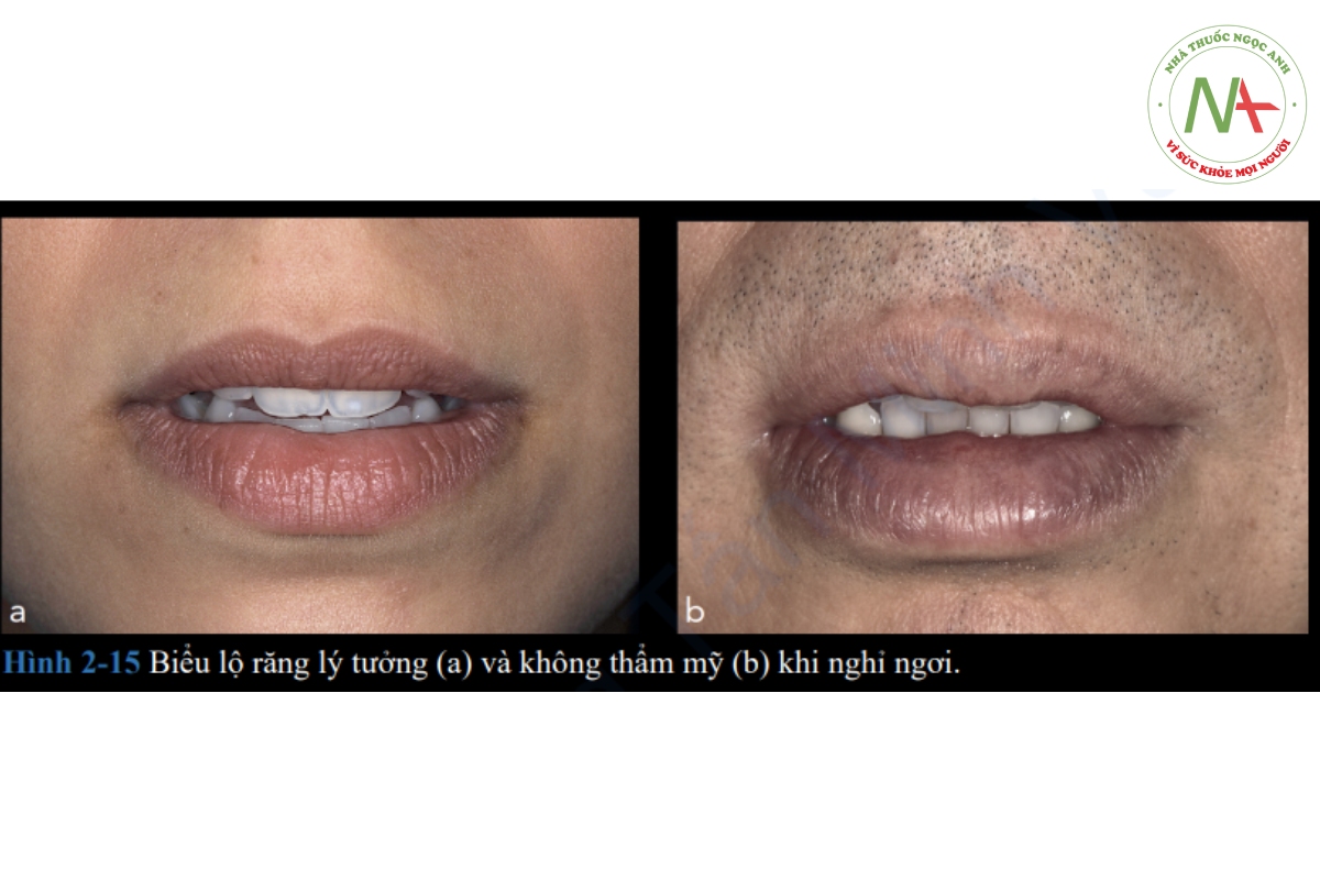 Hình 2-15 minh họa sự biểu lộ răng lý tưởng khi thư giãn và sự biểu lộ răng không thẩm mỹ khi thư giãn.