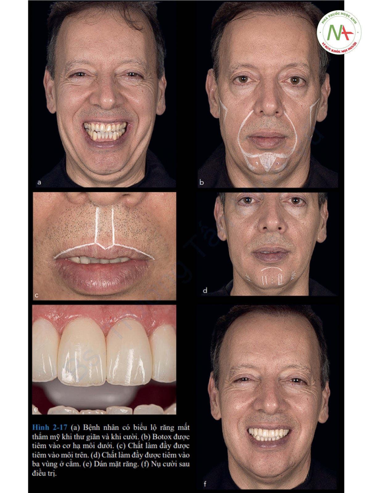 Hình 2-17 (a) Bệnh nhân có biểu lộ răng mất thẩm mỹ khi thư giãn và khi cười. (b) Botox được tiêm vào cơ hạ môi dưới. (c) Chất làm đầy được tiêm vào môi trên. (d) Chất làm đầy được tiêm vào ba vùng ở cằm. (e) Dán mặt răng. (f) Nụ cười sau điều trị.