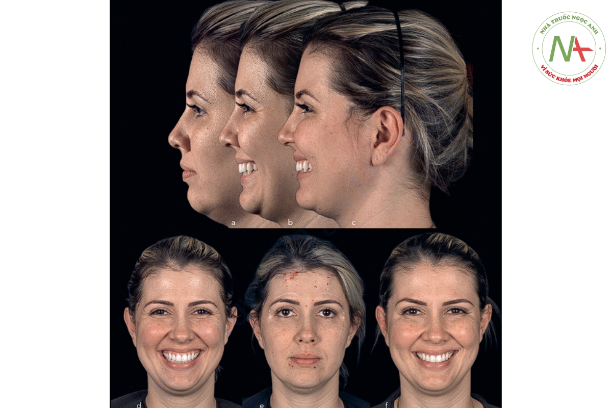 Hình 2-19 (a đến f) Các nếp nhăn động quanh mắt của bệnh nhân bắt đầu thành dạng nếp nhăn tĩnh, vì vậy chúng được điều trị bằng BTX. Cười hở lợi cũng được điều trị bằng cách tiêm BTX vào cơ hạ vách mũi, làm giảm thêm các nếp nhăn ở mắt. Hình ảnh cuối cho thấy ít nếp nhăn động hơn rõ rệt (f).