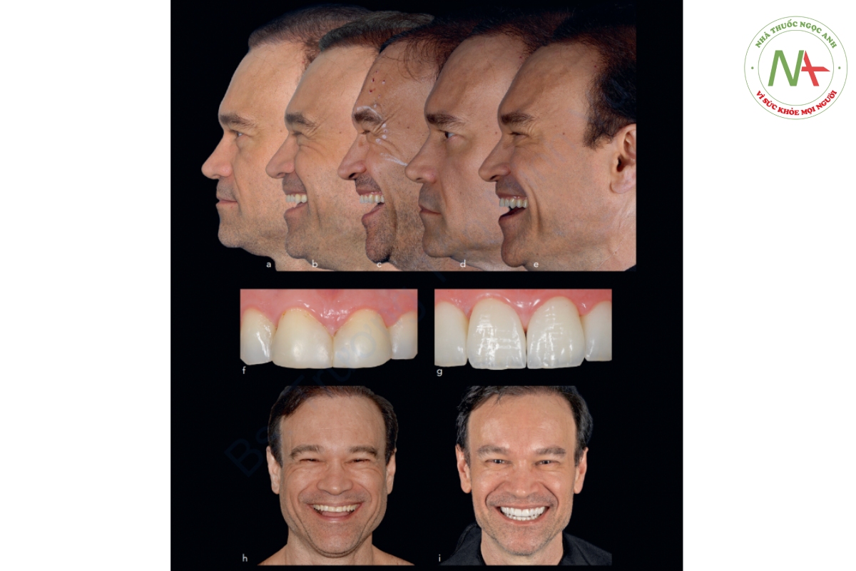Hình 2-20 (a đến e) Các nếp nhăn quanh ổ mắt của bệnh nhân vẫn xuất hiện ngay cả khi khuôn mặt ở trạng thái nghỉ ngơi, vì vậy việc điều trị bằng BTX được thực hiện để làm phẳng chúng. (f và g) Phục hình các răng trước hàm trên để kéo dài thân răng và mang lại cho khuôn mặt kéo dài hơn. (h và i) So sánh nụ cười trước và sau điều trị. Lưu ý vẻ ngoài trẻ trung hơn sau khi điều trị.