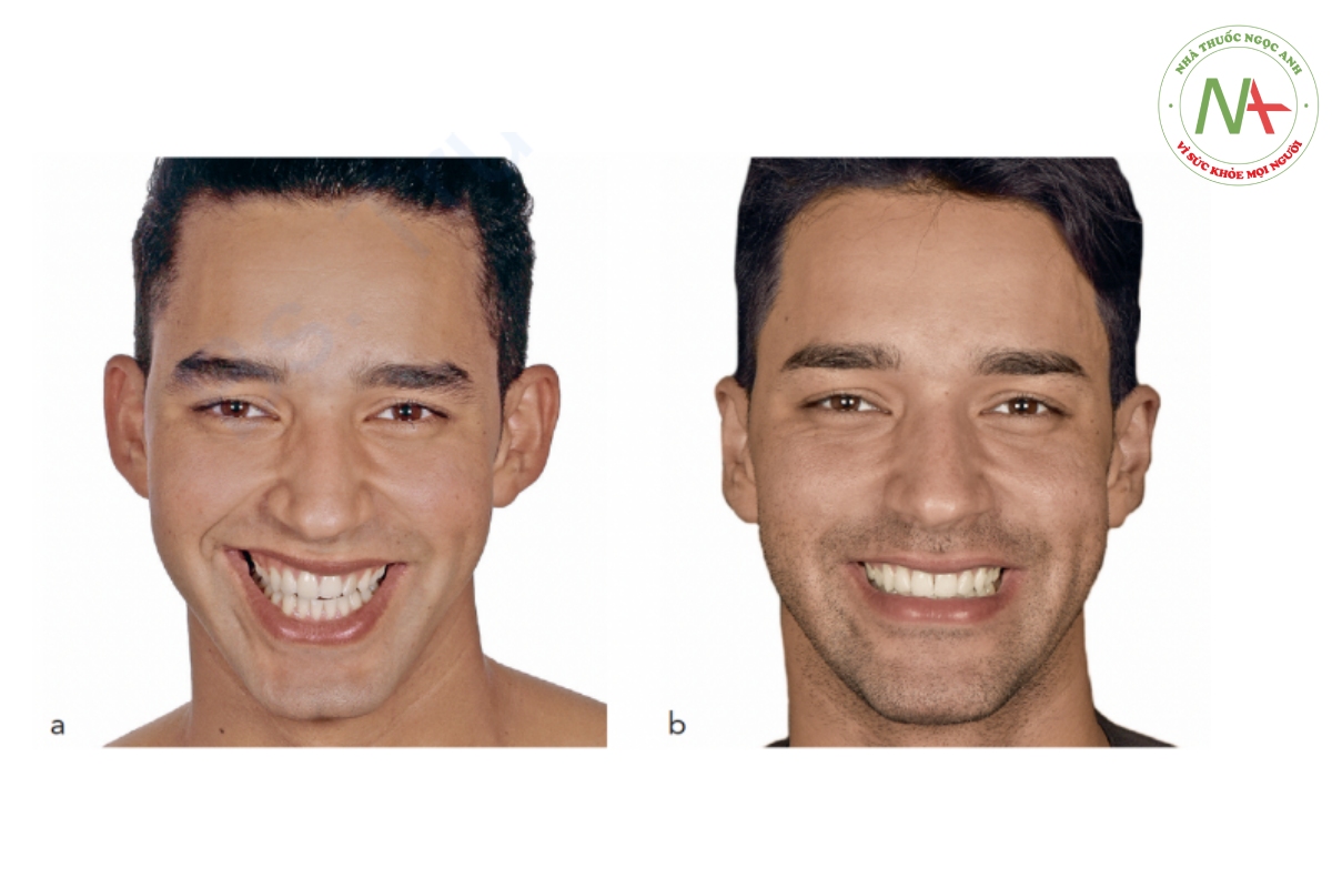 Hình 2-21 (a và b) Bệnh nhân có sự bất đối xứng về đường viền má và góc miệng và sau khi điều trị bằng BTX.