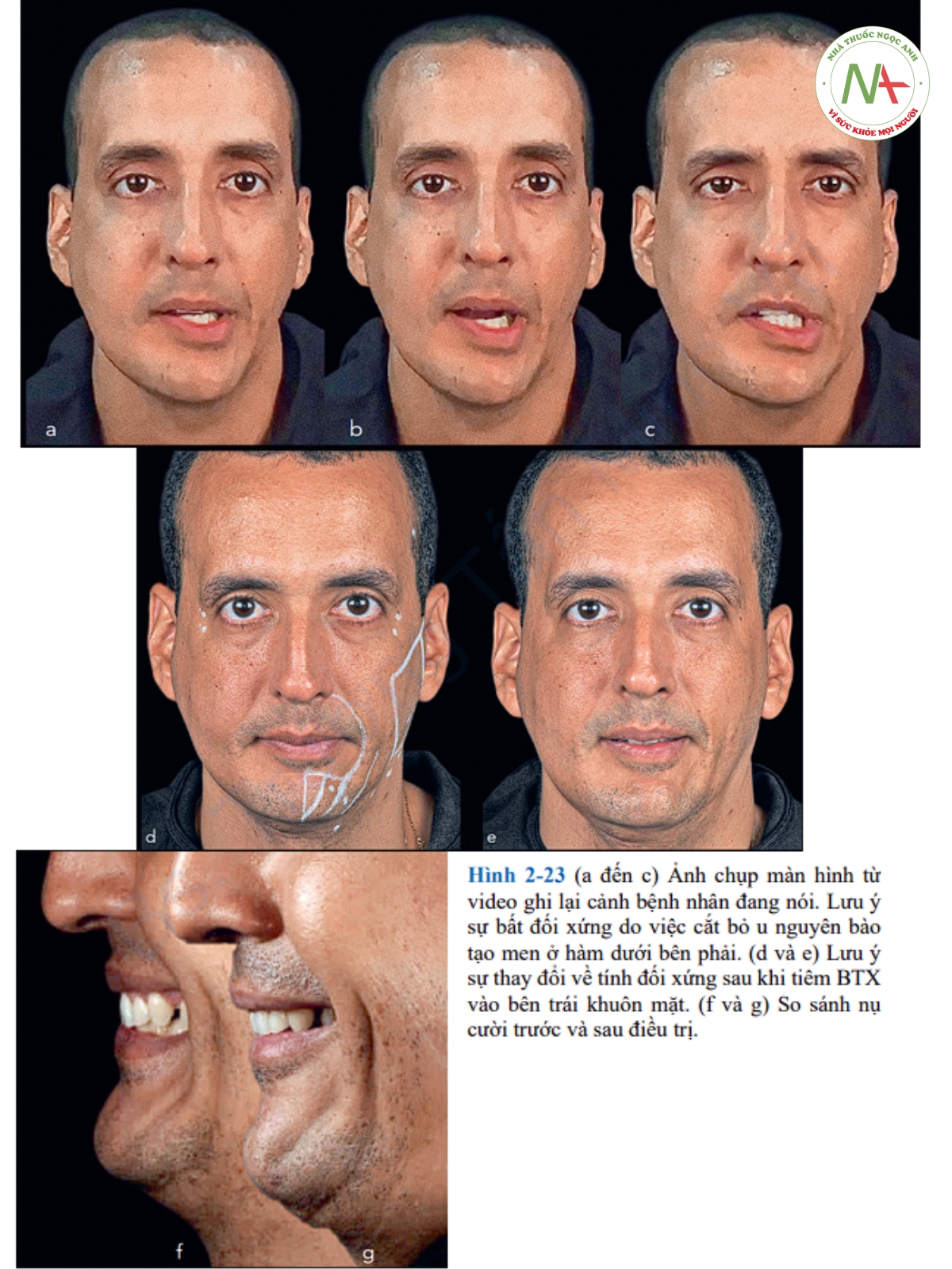Hình 2-23 (a đến c) Ảnh chụp màn hình từ video ghi lại cảnh bệnh nhân đang nói. Lưu ý sự bất đối xứng do việc cắt bỏ u nguyên bào tạo men ở hàm dưới bên phải. (d và e) Lưu ý sự thay đổi về tính đối xứng sau khi tiêm BTX vào bên trái khuôn mặt. (f và g) So sánh nụ cười trước và sau điều trị.
