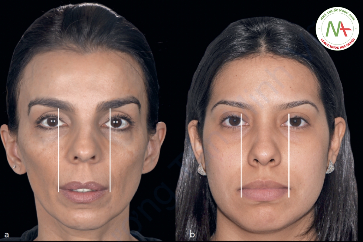 Hình 2-26 (a) Miệng tỷ lệ thuận với khuôn mặt, vì đường thẳng đứng tiếp xúc với mống mắt cũng tiếp tuyến với các góc miệng. (b) Miệng nổi bật, vì ở trạng thái thư giãn, các góc miệng nằm ngoài đường thẳng đứng tiếp xúc với mống mắt.