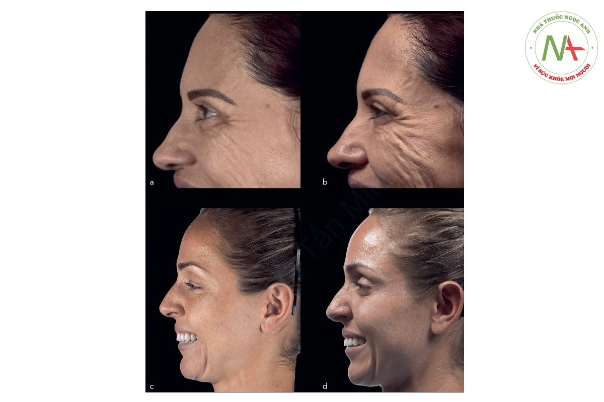 Hình 2-8 Vị trí đèn flash rất quan trọng khi chụp ảnh để chẩn đoán nếp nhăn, rãnh và thiếu hụt thể tích. (a và c) Các bức ảnh được sử dụng để chẩn đoán với đèn flash được đặt theo cách thông thường, nghĩa là ở cùng độ cao với khuôn mặt của bệnh nhân. (b và d) Ảnh chụp cùng ngày nhưng có đèn flash đặt phía trên so với mặt bệnh nhân. Lưu ý rằng mặc dù các bức ảnh cho thấy một số vùng tối, nhưng các nếp nhăn động ở cơ vòng mắt và cơ mũi vẫn có thể nhìn thấy rõ.