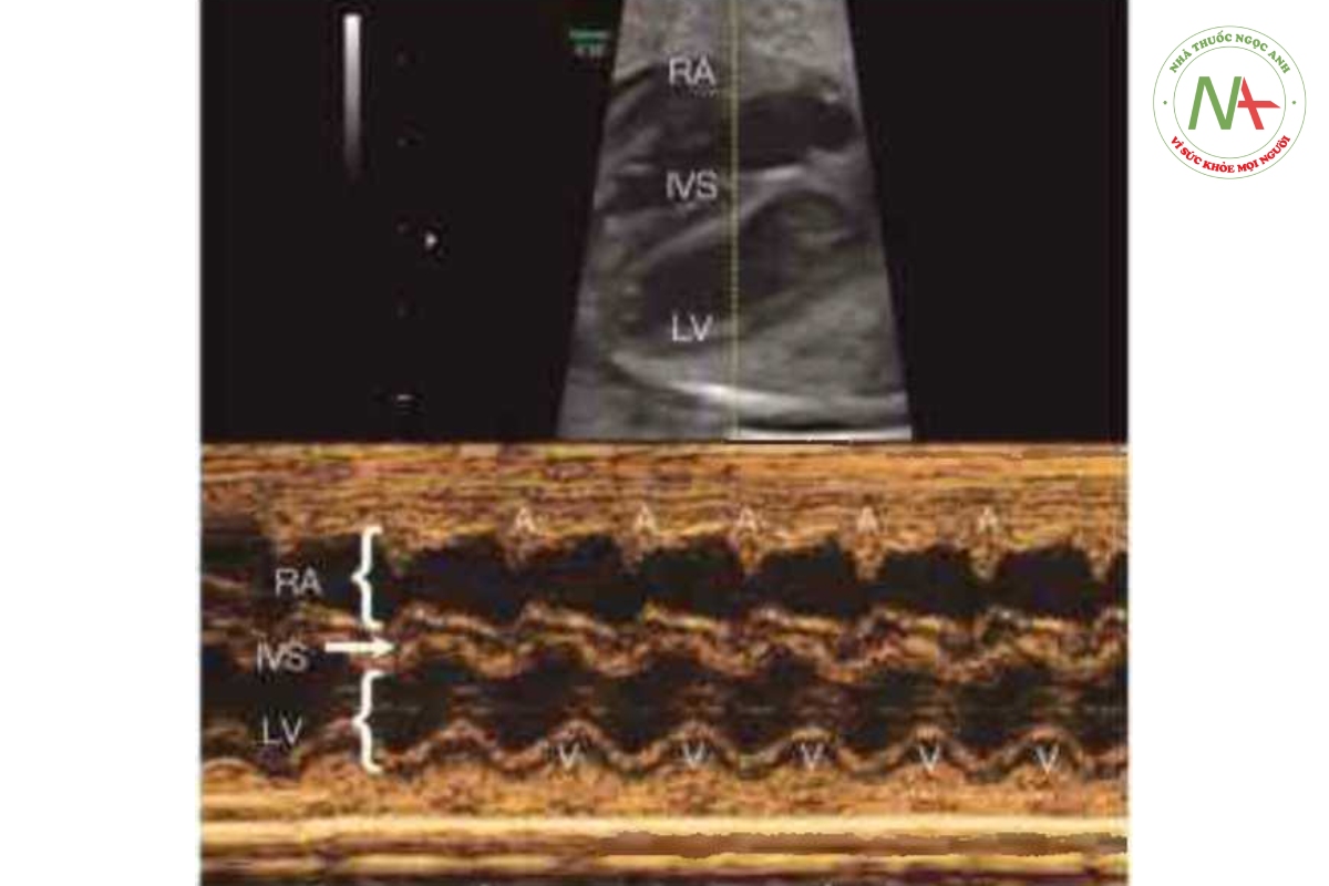Hình 46.1: Bản ghi M-mode nhịp xoang bình thường ở thai nhi. Thanh định hướng M-mode cắt qua tâm nhĩ phải (RA), vách liên thất (1VS) và tâm thất trái (LV). Bản ghi M-mode cho thấy tâm nhĩ (A) co và tâm thất (V) co tương ứng. 