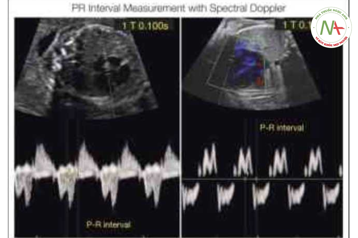 Hình 46.15: Khoảng PR ở hai thai nhi hình thường. Ở thai nhi A, khoảng PR (0,100 giây) được đo trên Doppler xung ở vùng van hai lá - van động mạch chủ. Ở thai nhi B, khoảng PR (0,142 giây) được đo trên Doppler mô ở vòng van phải (van ba lá - van động mạch phổi).