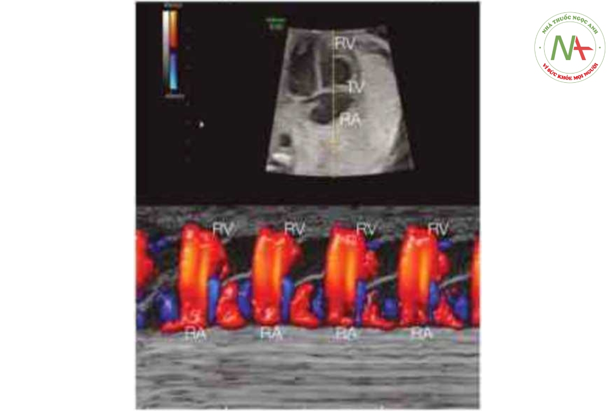 Hình 46.2: Bản ghi M-mode + Doppler màu nhịp xoang bình thường ờ thai nhi. Thanh định hướng M-mode cắt qua tâm nhĩ phải (RA), van ba lá (TV) và tâm thất phải (RV). Màu đỏ cho thấy sự đố đầy tâm trương từ RA vào RV. 