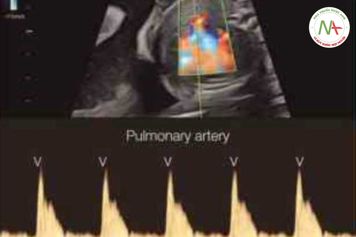 Hình 46.4: Doppler xung của động mạch phổi và tĩnh mạch ờ thai nhi có nhịp xoang bình thường. Các nhát tâm nhĩ co bóp (A) được xác định bởi sự bắt đầu của sóng A trong phổ Doppler tĩnh mạch phối và các nhát tâm thất co bóp (V) được xác định bởi dòng chảy của động mạch phổi. 