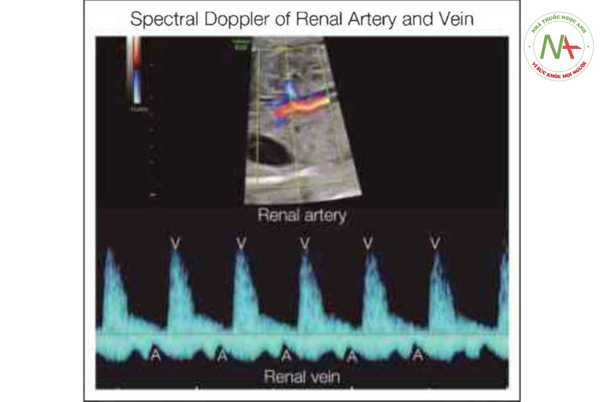 Hình 46.5: Doppler xung của động mạch thận và tĩnh mạch ở thai nhi có nhịp xoang bình thường. Các nhát tâm nhĩ co bóp (A) được xác định bởi sự bắt đầu của sóng A trong phổ Doppler tĩnh mạch thận và các nhát tâm thất co bóp (V) được xác định bởi dòng chảy của động mạch thận.