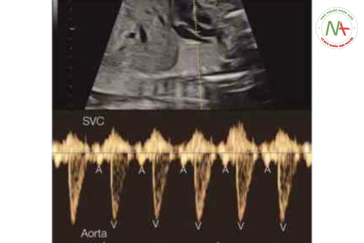 Hình 46.6: Doppler xung của động mạch chủ và tĩnh mạch chủ trên (SVC) ờ thai nhi có nhịp xoang bình thường. Các nhát tâm nhĩ co bóp (A) được xác định bởi sóng A chảy ngược (retrograde) trong svc và các nhát tâm thất co bóp (V) bởi dòng chảy của động mạch chủ. 