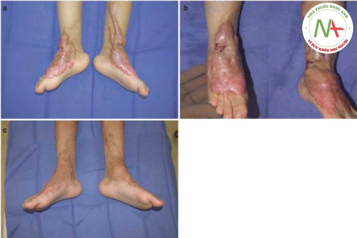 Hình 14.3 (a) Các vết sẹo bỏng phì đại lớn ở cẳng chân, mắt cá chân và bàn chân 1 năm sau chấn thương bỏng. Ban đầu, ban đỏ và ngứa được điều trị bằng PDL. (b) Lực căng trên các khớp mắt cá chân đã được giảm bớt bằng các phẩu thuật z-plasties nhỏ. (c) Năm năm sau, sau 12 lần điều trị bằng laser với CO2 AFL và corticosteroid tại chỗ, sẹo phì đại đã hoàn toàn biến mất. Không có mô sẹo nào được cắt bỏ.