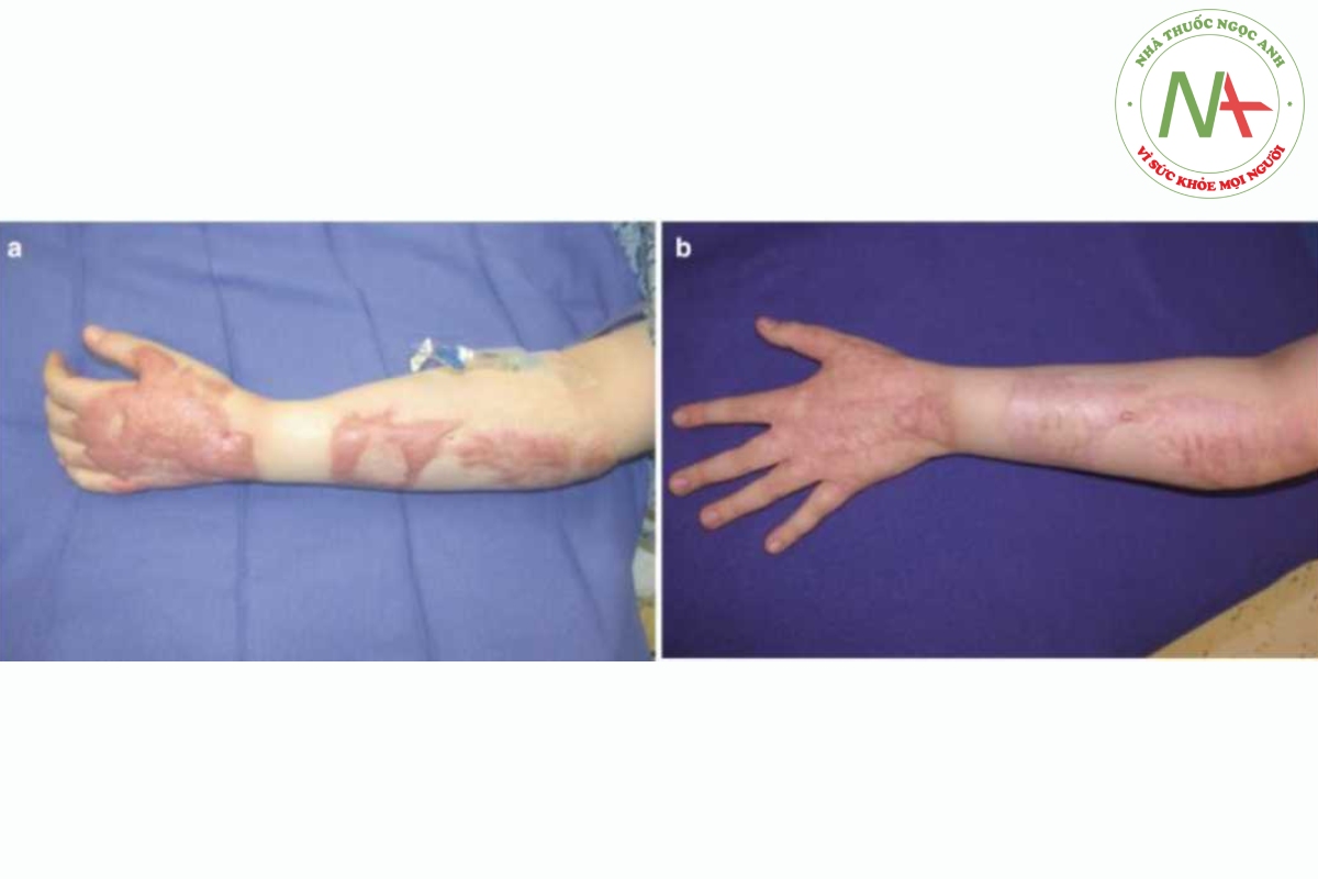 Hình 14.4 (a) Sẹo bỏng phì đại và tăng sinh mạch máu ở cánh tay và bàn tay 11 tháng sau vết thương bỏng lửa 16% ở một bệnh nhân nam 10 tuổi. Vết sẹo nhô ra từ 1,0—1,5 cm trên vùng da không bị thương lân cận. (b) Năm năm sau, sau 2 lần điều trị PDL và 11 CO2 AFL, ban đỏ được loại bỏ và tình trạng phì đại cơ bản được giải quyết. Hai phương pháp điều trị PDL được thực hiện đồng thời với hai phương pháp điều trị AFL đầu tiên. Triamcinolone tại chỗ được sử dụng sau tất cả các AFL để giảm các triệu chứng sau điều trị và nâng cao kết quả điều trị. Cắt bỏ sẹo không bao giờ được chỉ định.