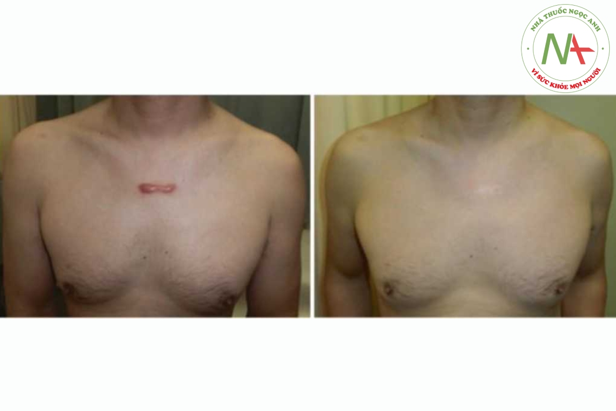 Hình 12.2 Một người đàn ông 45 tuổi, có sẹo lồi trước ngực được điều trị bằng băng dán trong 36 tháng