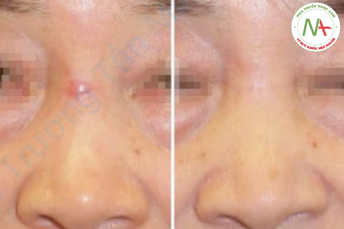 Hình 12.3 Kết quả của việc dùng kéo dài 2 tháng trên sẹo phì đại ở mũi của một bệnh nhân nữ 73 tuổi