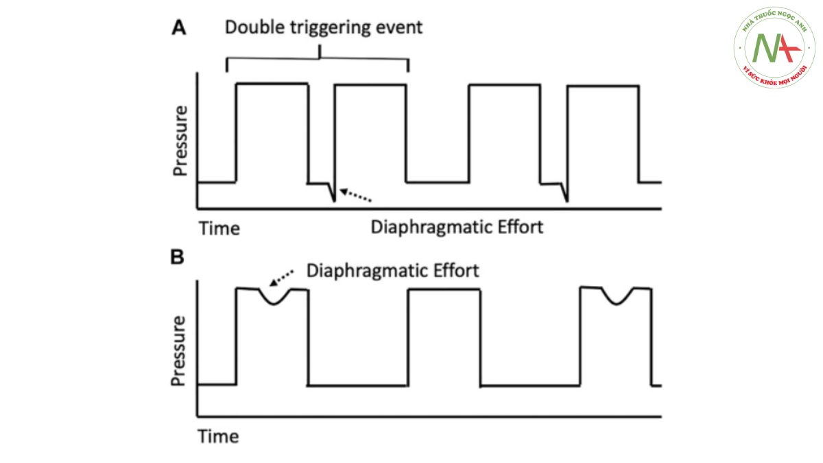 Đường cong áp lực-thời gian được đơn giản hóa cho sự kiện kích hoạt ngược có thể xảy ra