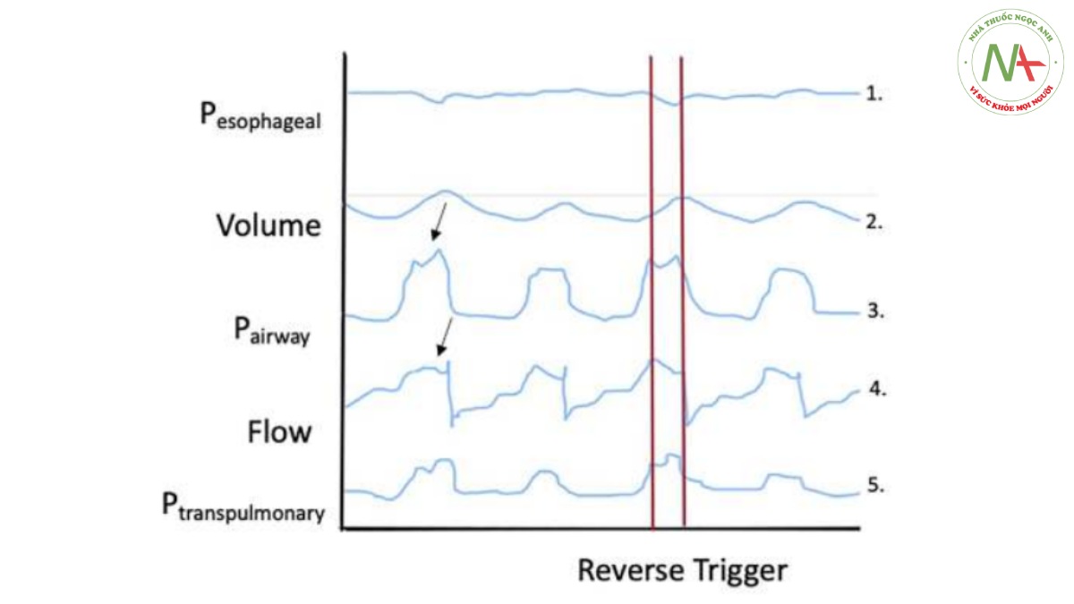 Hình 3 Mô tả lý thuyết về việc dò tìm dạng sóng cho một sự kiện kích hoạt ngược.