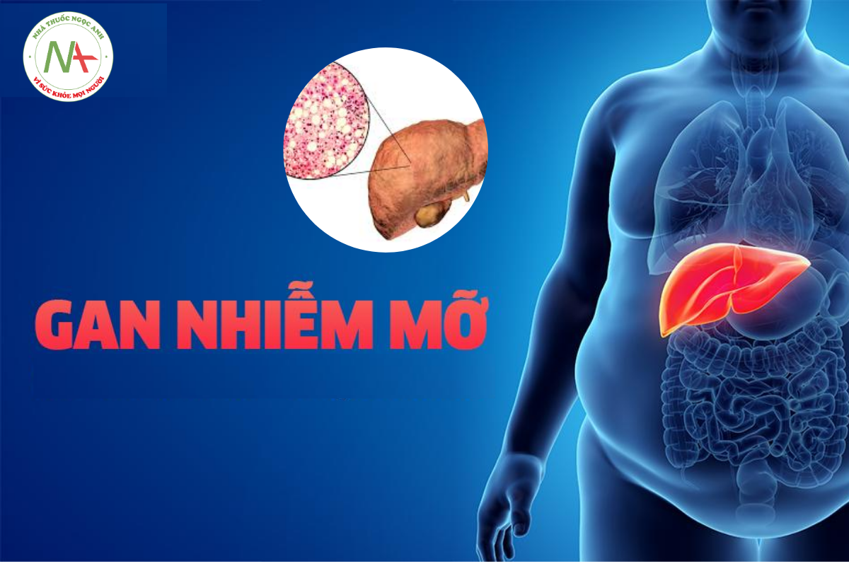 Mách bạn top 5+ thuốc điều trị gan nhiễm mỡ được bác sĩ khuyên dùng