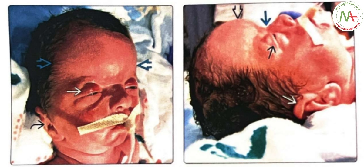 Hình ảnh lâm sàng của một trẻ sơ sinh đủ tháng mắc hội chứng Apert