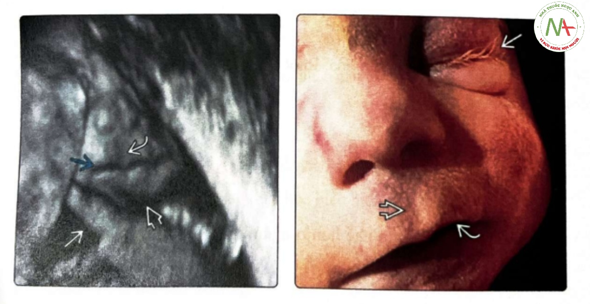 Hình ảnh một phần khuôn mặt của thai nhi mắc CdLS