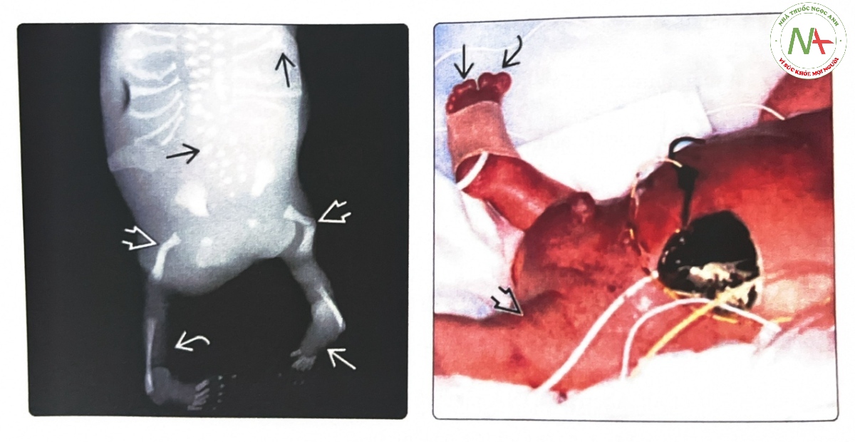 Hình ảnh thai nhi chết lưu và trẻ bị thiểu sản xương đùi do đái tháo đường