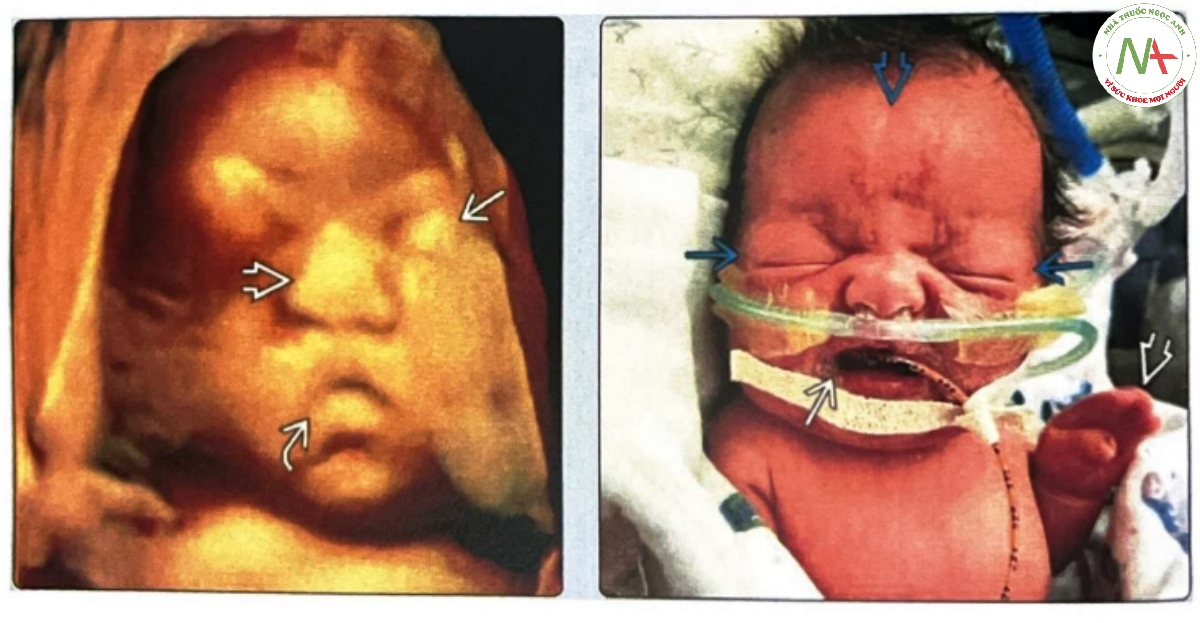 Hình ảnh thai nhi và trẻ sơ sinh mắc hội chứng Apert