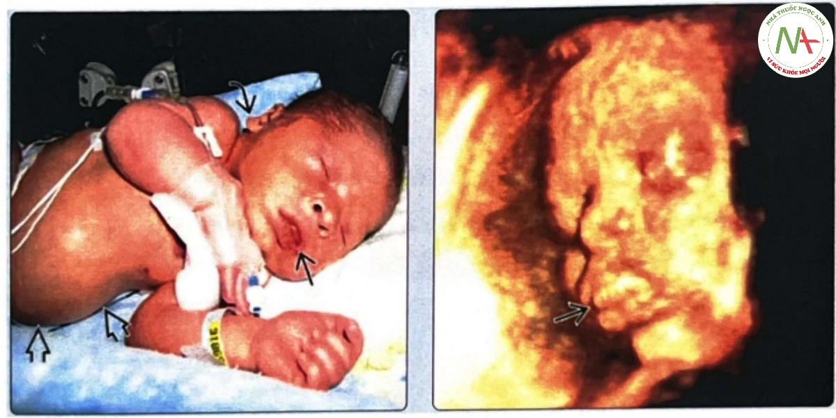 Hình ảnh trẻ sơ sinh và thai nhi mắc BECKWITH-WIEDEMANN