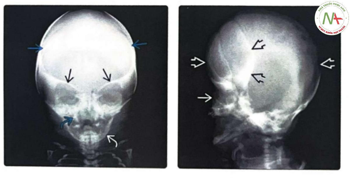 Phim chụp X-quang trước-sau của trẻ sơ sinh mắc hội chứng Apert 