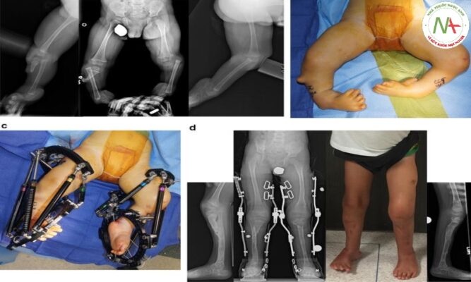 Bất sản đoạn xa xương chày/xương mác (FIBULAR/TIBIAL HEMIMELIA)