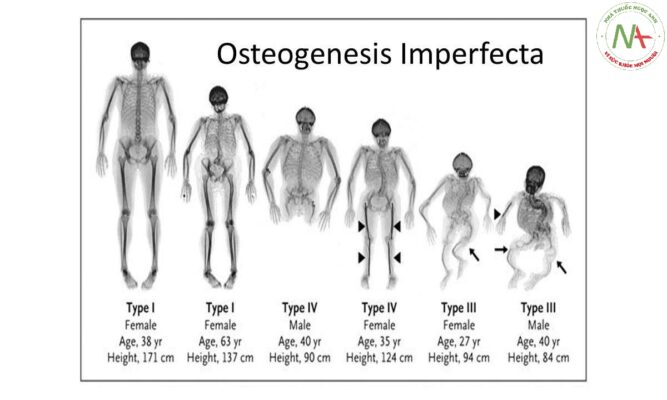 Bệnh tạo xương bất toàn (OSTEOGENESIS IMPERFECTA)