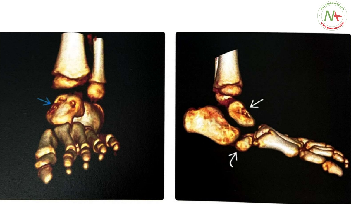 CT xương tái tạo 3D được thực hiện ở một đứa trẻ có xương sên nằm dọc bẩm sinh