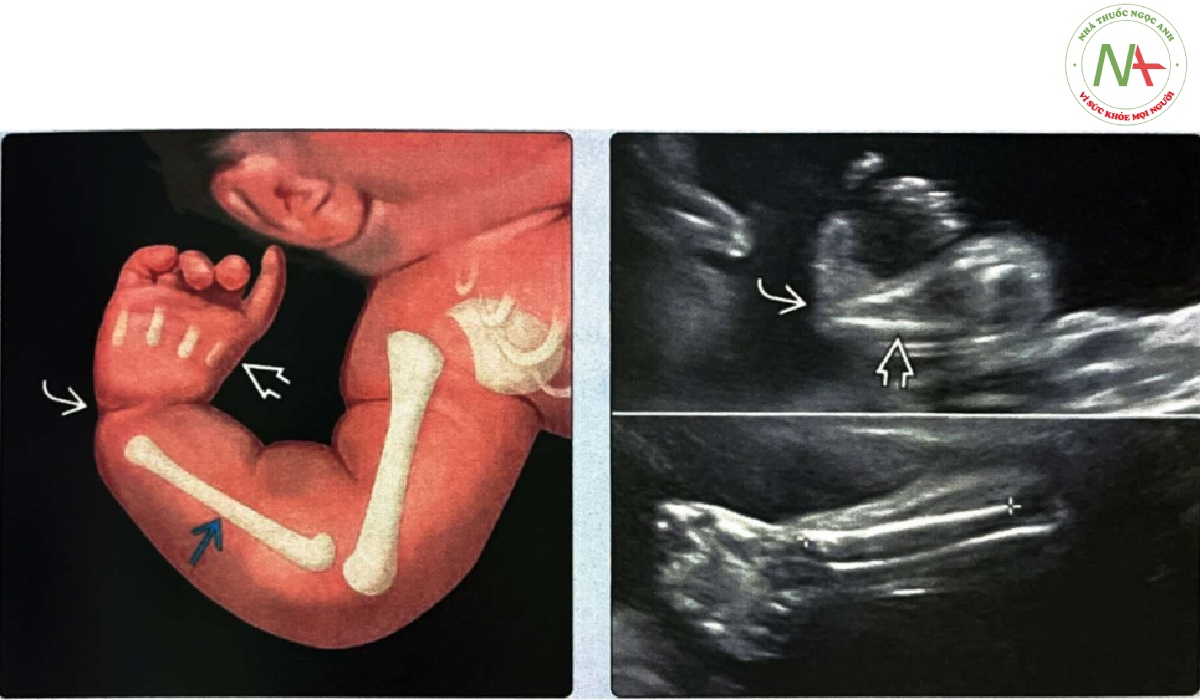 Các đặc điểm đặc trưng của dị tật trục xương quay (radial ray malformation)