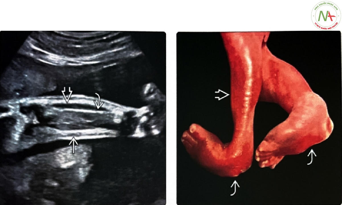 Chân dưới của thai nhi ở quý 2 bị co cứng khớp với các dấu hiệu điển hình