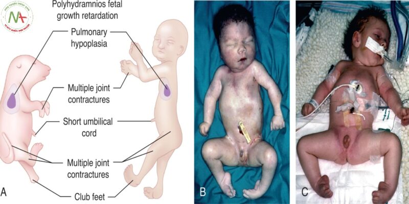 Co cứng khớp chuỗi mắt vận động thai nhi (ARTHROGRYPOSIS, AKINESIA SEQUENCE)