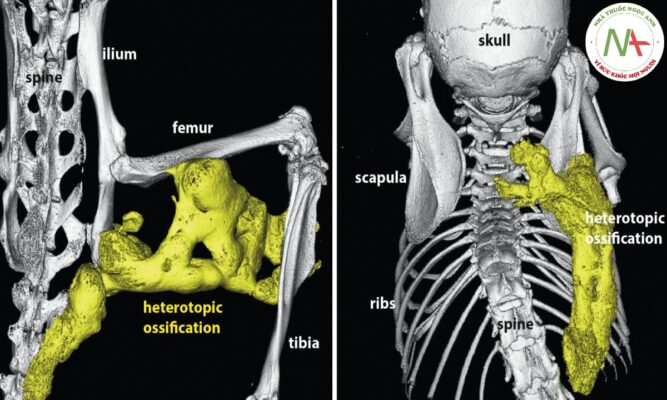 Cốt hóa bất thường (ABNORMAL OSSIFICATION)