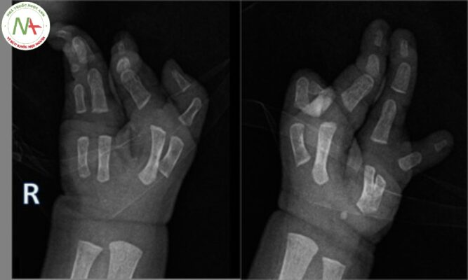 Dị tật bàn tay/chân chẻ đôi (SPLIT HAND/FOOT MALFORMATION)