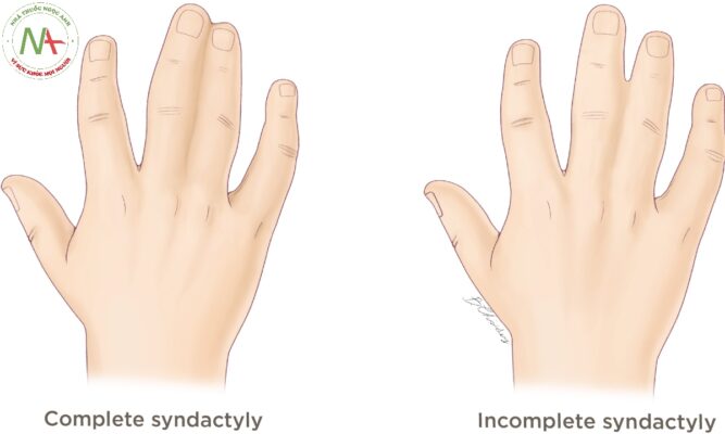 Dính ngón (SYNDACTYLY)