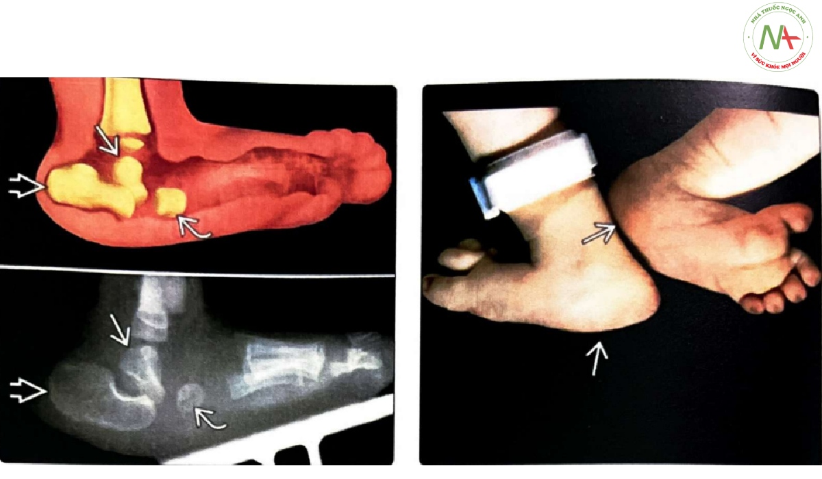Hình ảnh đồ hoạ và phim X-quang bàn chân của một trẻ sơ sinh có phức hợp VACTERL