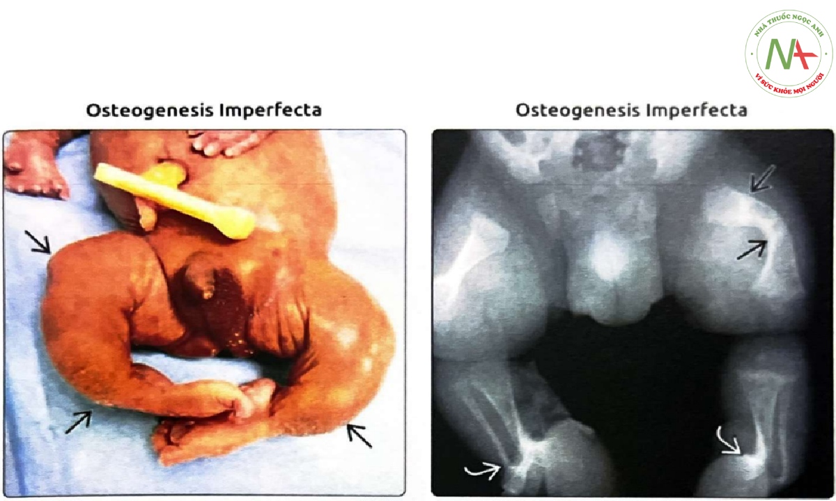 Hình ảnh lâm sàng cho thấy các đặc điểm điển hình của chi dưới ở trẻ mắc OI gây chết chu sinh loại II.