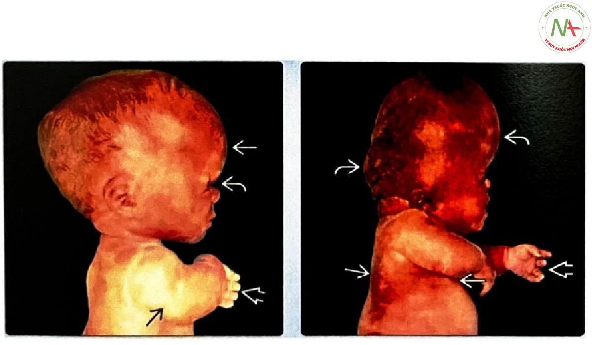 Hình ảnh lâm sàng của loạn sản xương gây chết (thanatophoric dysplasia-TD) loại I