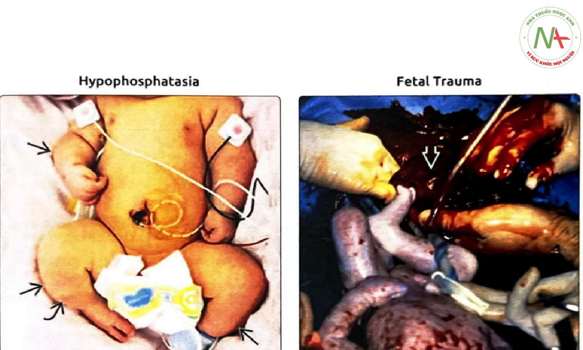 Hình ảnh một trẻ sơ sinh bị giảm phosphatase kiềm (hypophosphatasia) gây chết chu sinh