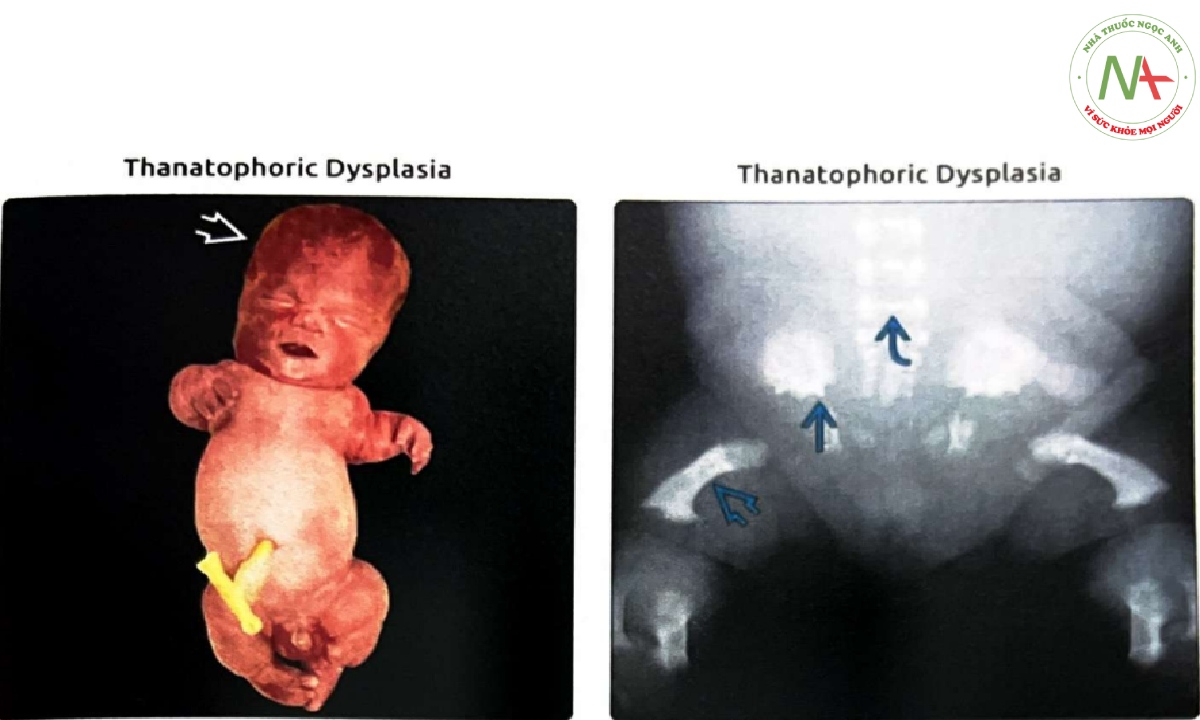 Hình ảnh trẻ sơ sinh đủ tháng chết lưu mắc loạn sản xương gây chết (thanatophoric dysplasia) loại I